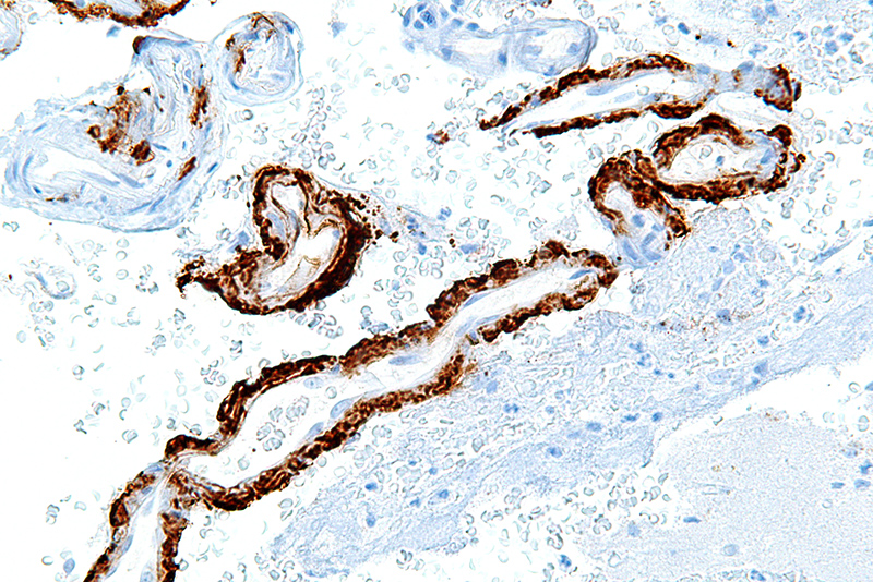 Kahverengi oluşum Alzheimer'ın sebebi Amela proteini.
