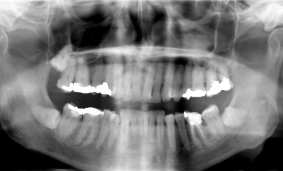 stem-cell-teeth-cavity-root-canal
