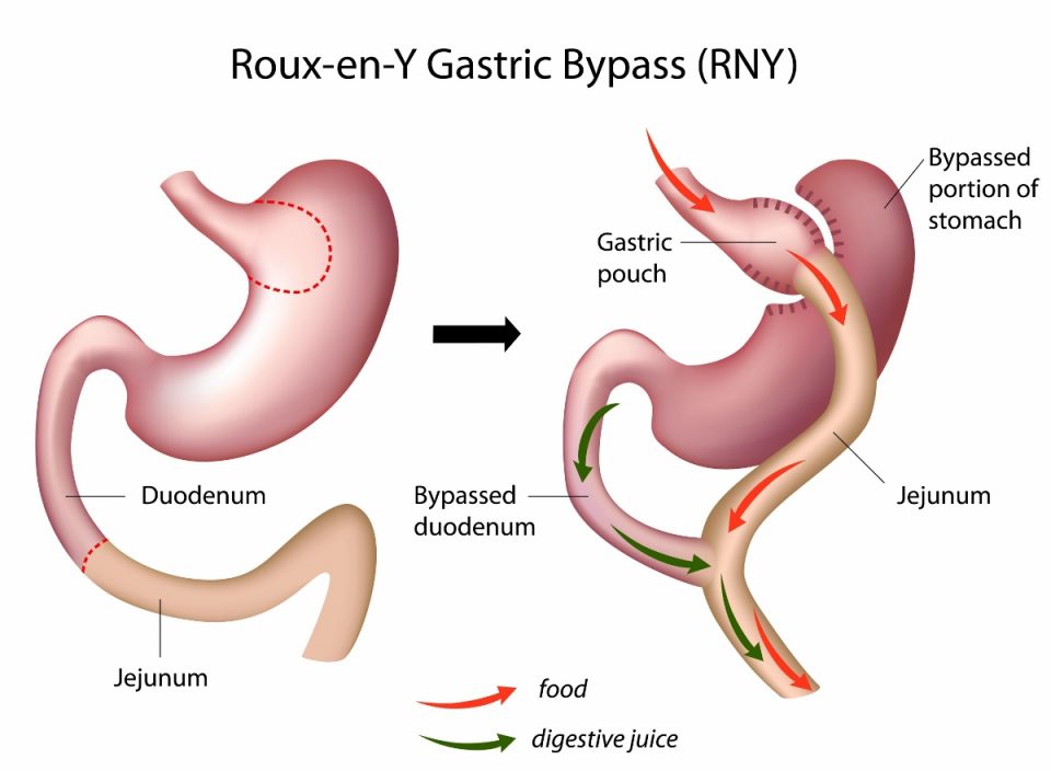 Laparoscopic-Gastric-Bypass-ReY (1200x880)