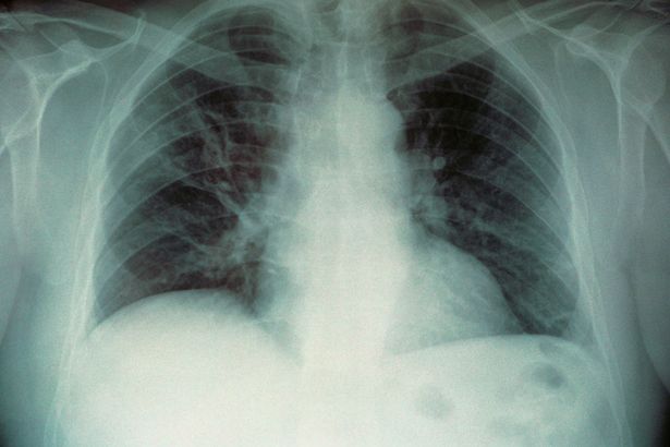x-ray-image-of-lungs-with-legionella-pneumophila