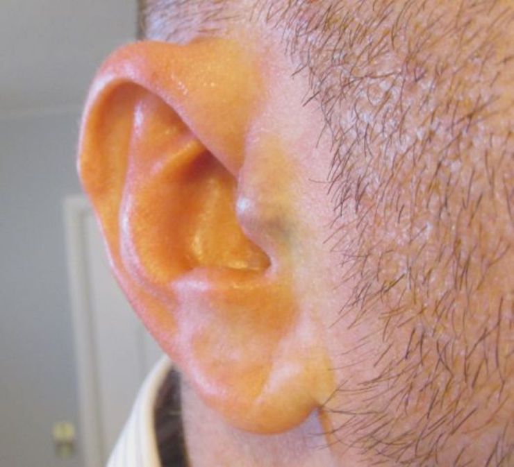 earcl