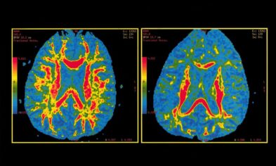 Alzheimer’a yakalanma yaşını belirleyen test