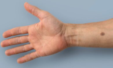 Kanseri haber vermeyi amaçlayan deri implantı